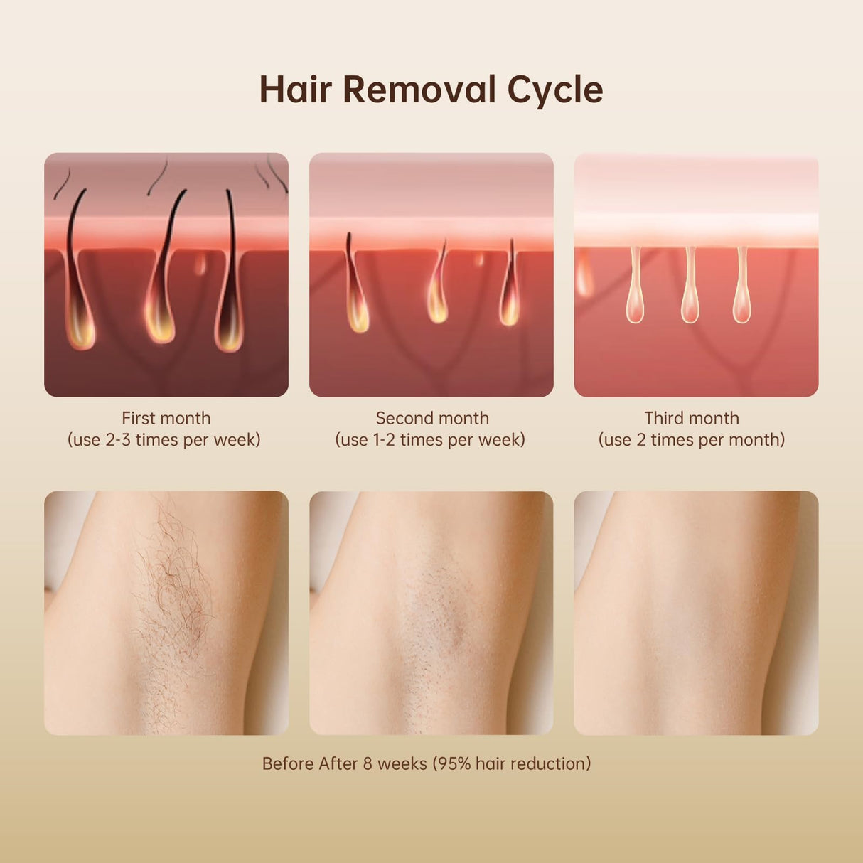 Laser Hair Removal, IPL Laser Hair Removal for Women and Men Permanent, 999999 Flashes, At-Home Hair Removal Device for Facial Legs Arms Whole Body ARTOLF