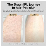 Braun IPL Long-lasting Laser Hair Removal Device for Women & Men, Silk Expert Pro5 PL5157, Safe & Virtually Painless Alternative to Salon Laser Hair Braun